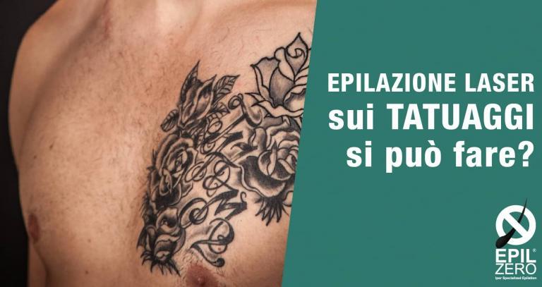 epilazione laser su tatuaggi