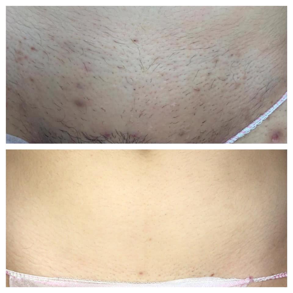 before and after laser hair removal bikini
